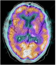 Nuclear Medicine Scan