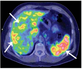 PET-CT Scan