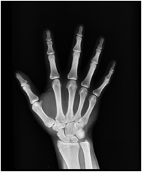 X-Ray
